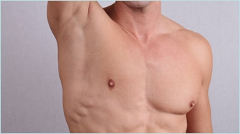 Chirurgie de réduction mammaire pour homme (Gynécomastie)