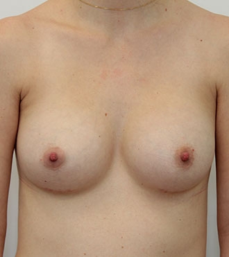 Breast Augmentation Surgery, after