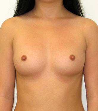 Breast Augmentation Surgery, before