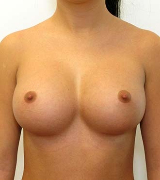Breast Augmentation Surgery, after