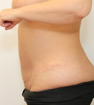 Abdominoplasty (Stomach Lift), after