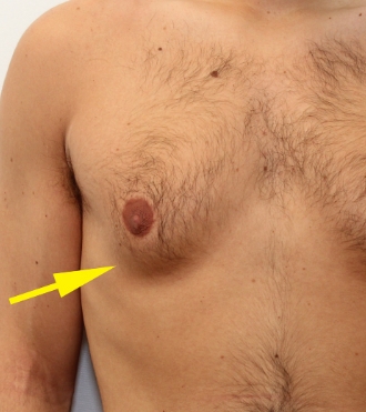 Chirurgie de réduction mammaire pour homme (Gynécomastie), avant