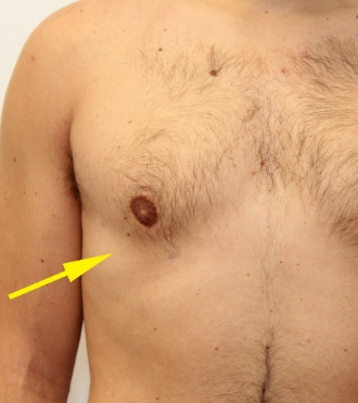 Chirurgie de réduction mammaire pour homme (Gynécomastie), après
