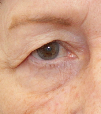 Eyelid Surgery (Blepharoplasty), before