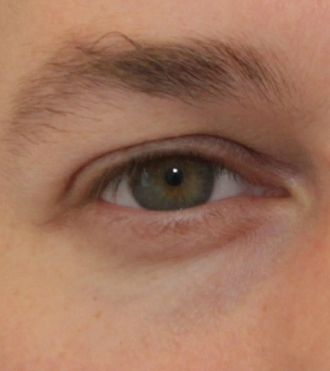 Eyelid Surgery (Blepharoplasty), before