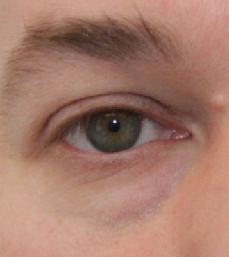 Eyelid Surgery (Blepharoplasty), after