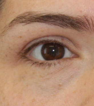 Eyelid Surgery (Blepharoplasty), after