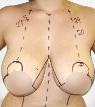 Réduction mammaire, avant
