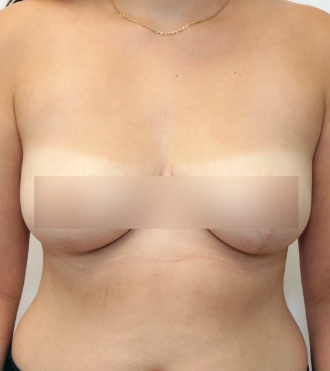 Breast Reduction Surgery, after
