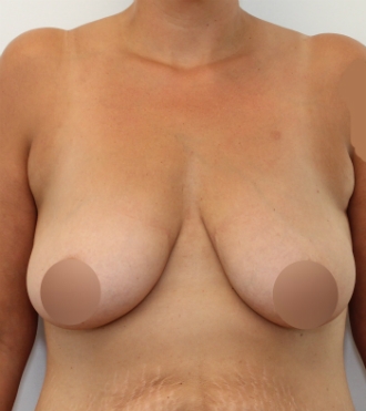 Redrapage mammaire (Mastopexie), avant