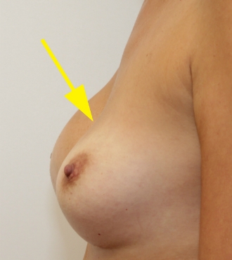Breast Prosthesis Replacement, before