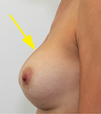Breast Prosthesis Replacement, after