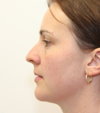 Rhinoplastie (chirurgie du nez), avant