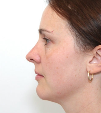 Rhinoplasty (Nose Job), after