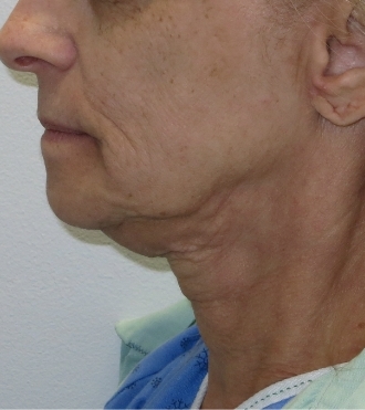 Redrapage du visage (Rhytidectomie), avant