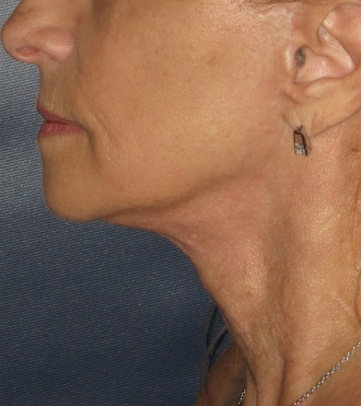 Redrapage du visage (Rhytidectomie), après