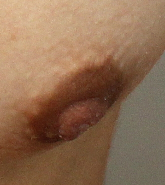 Flat or Inverted Nipple Treatment, before