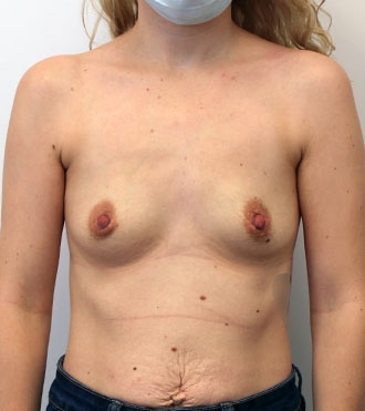 Breast Augmentation Surgery, before