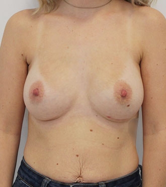 Chirurgie augmentation mammaire, après